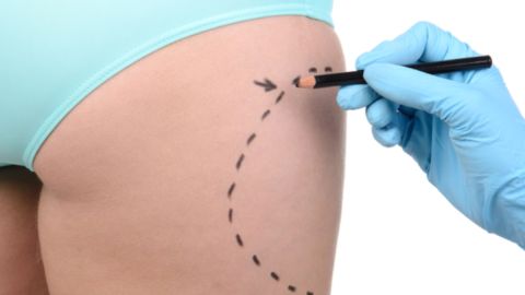 Cirugía estética: las “reversiones” también están de moda